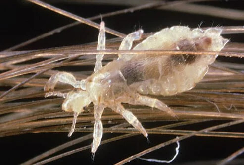 close up view of head louse in hair