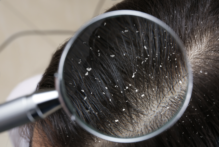 Causes of an Itchy Scalp Is It Head Lice? Lice Clinic Wisconsin Is