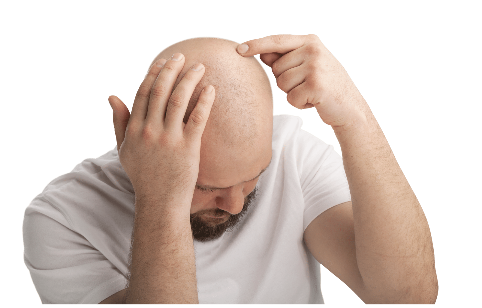 Bald Men and Head Lice Debunking Myths and Understanding Risks Lice